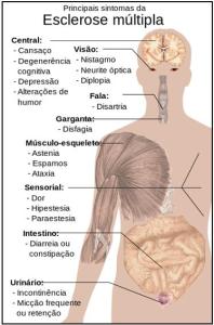 esclerose multipla sintomas
